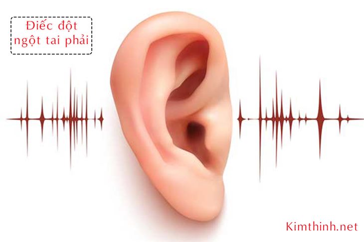 Cải thiện điếc đột ngột tai phải an toàn hiệu quả nhờ sản thảo dược