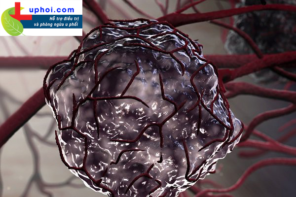 Cách điều trị u phổi ác tính bằng tế bào gốc và những điều bạn cần biết!