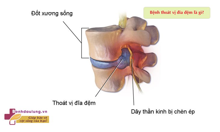 Tại sao nên sử dụng Cốt Thoái Vương để cải thiện thoát vị đĩa đệm? 