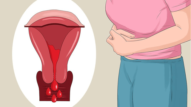 Lạc nội mạc tử cung là gì? Bệnh hình thành như thế nào?