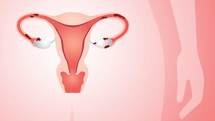 Lạc nội mạc tử cung gây ra những ảnh hưởng như thế nào?