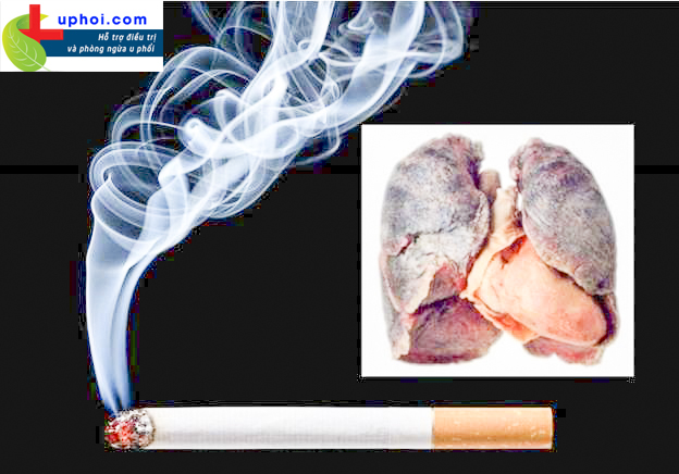 Thuốc lá - “Thủ phạm” hàng đầu gây ung thư phổi. Tìm hiểu ngay!