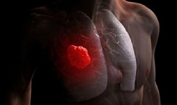 Bệnh ung thư phổi diễn biến nguy hiểm ra sao và ảnh hưởng tới sức khỏe như thế nào?