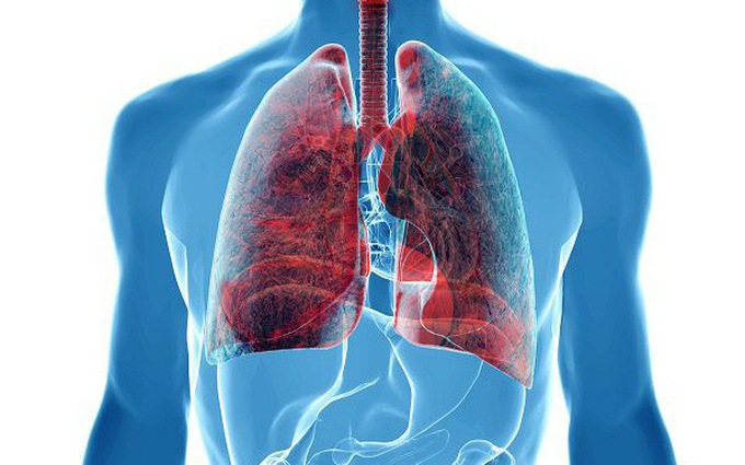 Ung thư phổi là gì? Thực trạng bệnh ung thư phổi ở nước ta và thế giới hiện nay như thế nào?