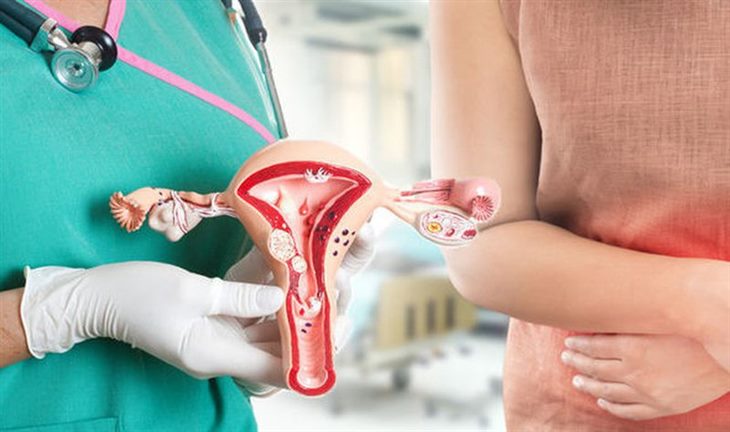 Phụ Lạc Cao EX - Giải pháp mới cho phụ nữ bị u lạc nội mạc tử cung không cần phẫu thuật
