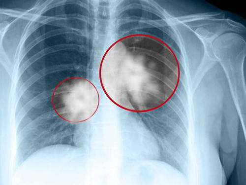 U phổi lành tính có nguy hiểm không? Dùng Tumolung hỗ trợ điều trị có được không?