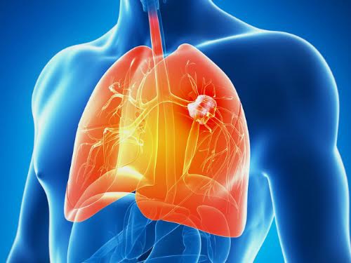 Bị ung thư phổi sống được bao lâu?