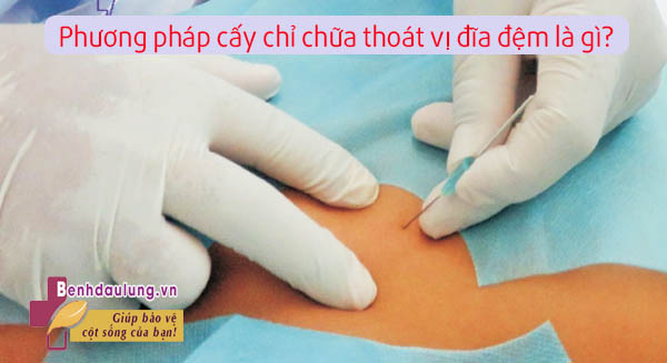 Có nên áp dụng phương pháp cấy chỉ chữa thoát vị đĩa đệm không? 