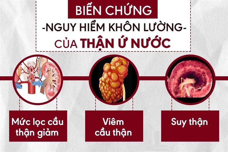 Các cấp độ bệnh thận ứ nước và cách điều trị hiệu quả nhất. Click xem ngay!