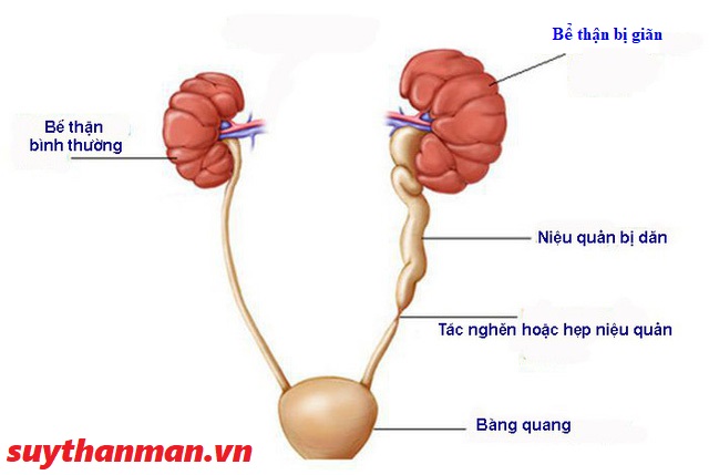 NOTE NGAY những kiến thức cơ bản về bệnh giãn đài bể thận ở trẻ nhỏ!