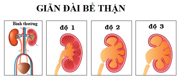 Giãn đài bể thận là bệnh gì, có nguy hiểm không? Xem ngay giải đáp của chuyên gia TẠI ĐÂY