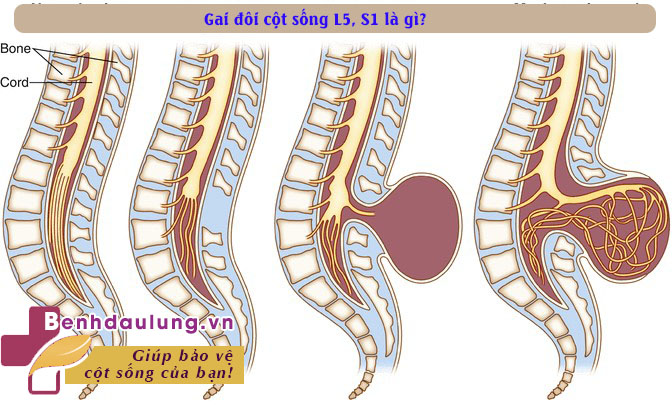 Gai đôi cột sống L5, S1 là gì? Có chữa khỏi được không?  