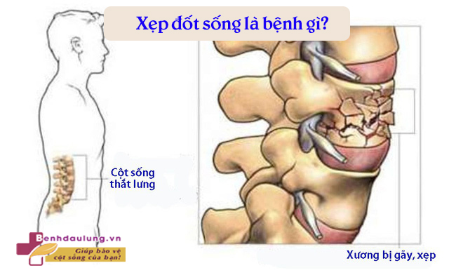 Ảnh hưởng của tình trạng xẹp đốt sống lưng đến sức khỏe và cuộc sống của người mắc như thế nào? 