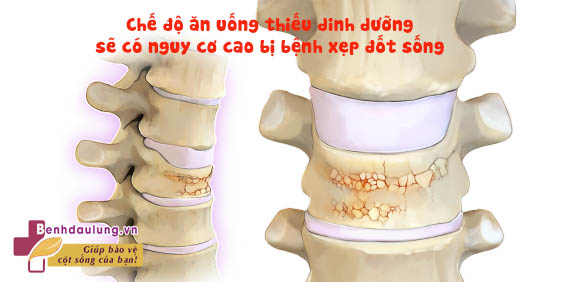 Không đi lại được, phải ngồi một chỗ do xẹp đốt sống – Làm thế nào để cải thiện?  