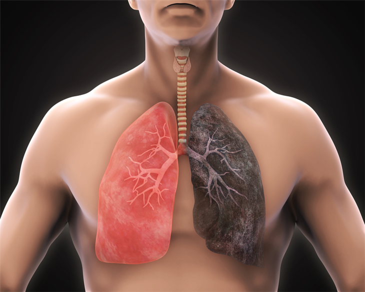 Bị đau phổi phải, ho khan và ho ra máu có phải dấu hiệu ung thư phổi không?