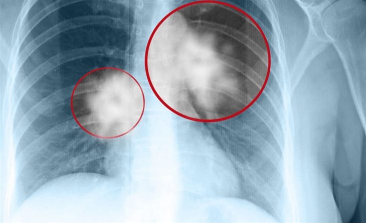 Bị ho nhiều, đau tức ngực khó thở có phải là triệu chứng u phổi không và phải làm sao?