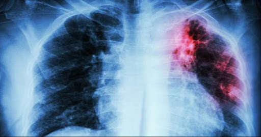 Bị lao phổi và có xuất hiện nấm phổi nên điều trị như thế nào?