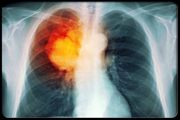 Làm sao để tăng cường sức khỏe cho người đang điều trị ung thư phổi giai đoạn 4 bằng hóa trị?