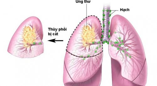 U phổi là bệnh lý như thế nào?
