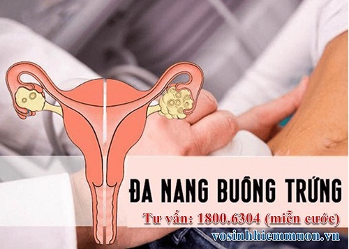 Nguyễn Thị Hải: Giải pháp có thai tự nhiên cho người bị buồng trứng đa nang