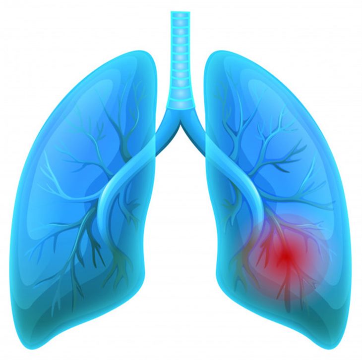Thời gian sống của người bị u phổi được đánh giá như thế nào? 