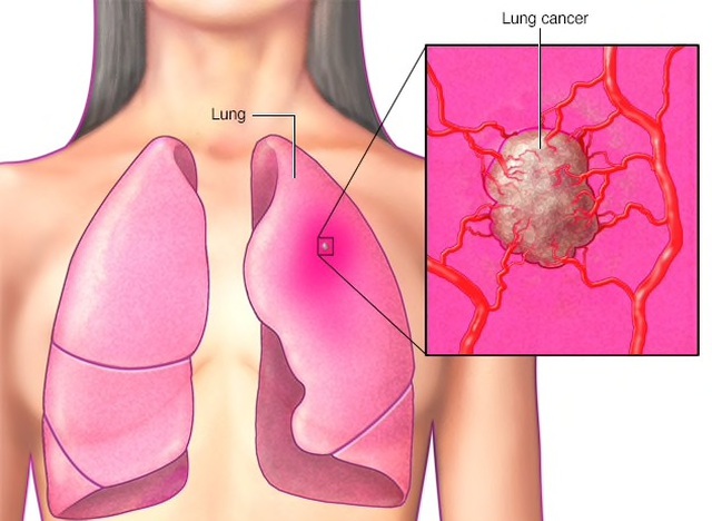 Tiên lượng sống của người bị u phổi hiện nay như thế nào?