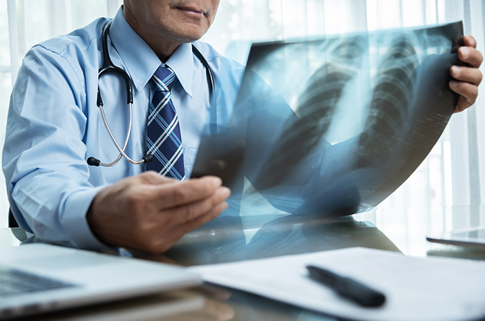 Làm sao để chẩn đoán chính xác bệnh u phổi?
