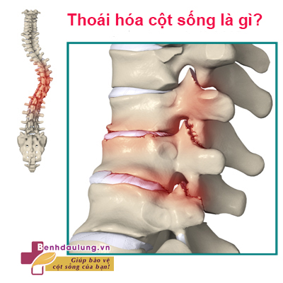 Thoái hóa cột sống – Xem ngay giải đáp từ CHUYÊN GIA