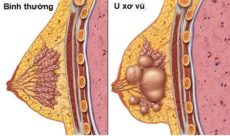 Bị ung thư vú đã phẫu thuật và đang xạ trị có dùng Oncolysin được không?