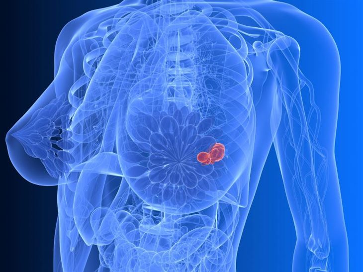 Bị ung thư vú giai đoạn 2a đã được điều trị, phải làm sao để ngăn ngừa bệnh tái phát?