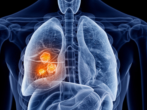 U phổi có nguy cơ diễn biến thành ung thư phổi không? Làm sao để phòng ngừa tình trạng này?
