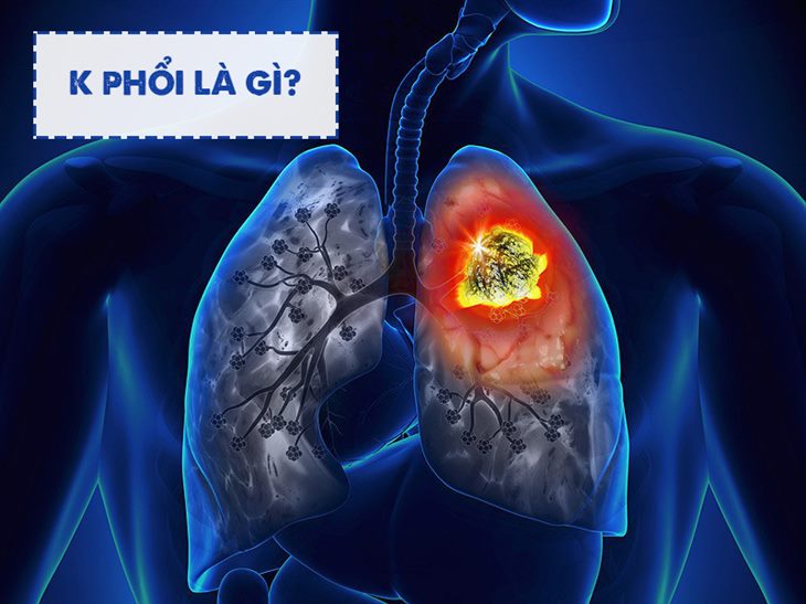 Ung thư phổi là gì? Bệnh được phân loại như thế nào? 
