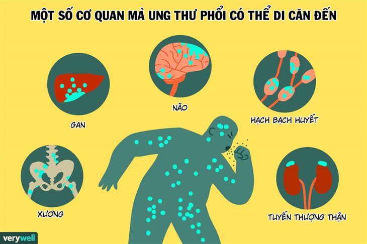 Triệu chứng ung thư phổi là gì? "Ngón tay dùi trống" có phải là dấu hiệu để nhận biết bệnh không?