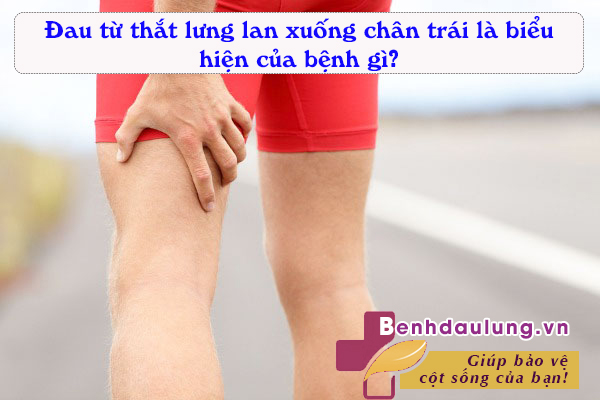 Đau từ thắt lưng xuống chân trái – Coi chừng 3 căn bệnh nghiêm trọng này!