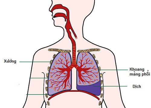 Làm sao để phòng bệnh lao phổi? Bệnh có gây ra nguy cơ hình thành khối u phổi không?