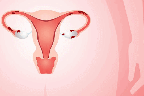 Những yếu tố gây lạc nội mạc tử cung là gì? Nếu có người thân bị bệnh thì nguy cơ mắc có cao không?