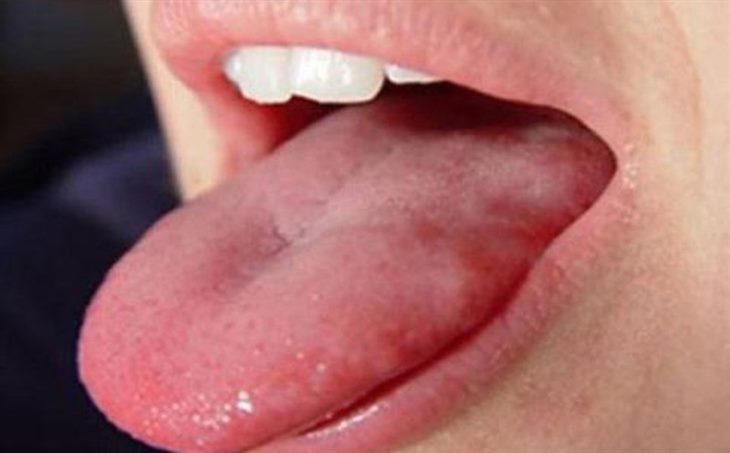 Viêm họng hạt ở lưỡi là gì? Có nguy hiểm không? Click, xem ngay!