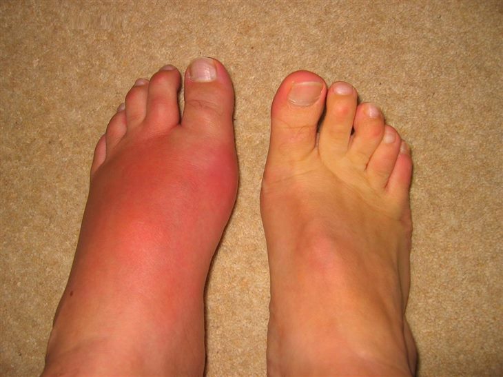 Hay bị đau ngón chân cái lúc nửa đêm có phải do bệnh gút không và phải làm sao?
