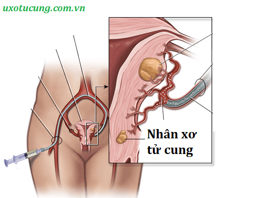 Nhân xơ tử cung 20mm và cách điều trị bệnh an toàn, hiệu quả từ ...