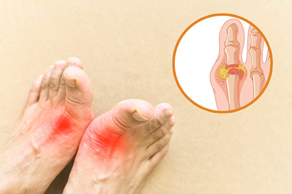 Bị nhức ngón chân cái, cổ tay và chỉ số axit uric cao có phải là dấu hiệu bị bệnh gút không?