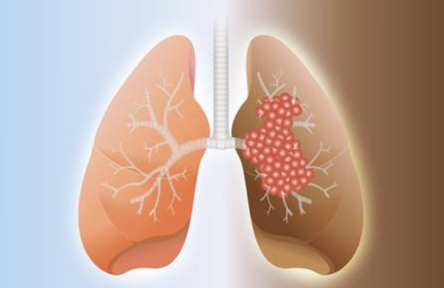 Bị ung thư phổi giai đoạn cuối phải làm sao để cải thiện sức khỏe? Chuyên gia Phan Văn Dân tư vấn