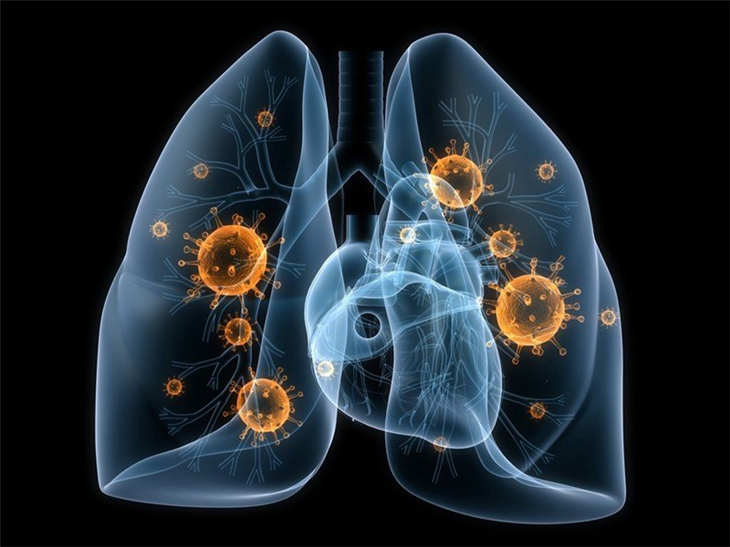 Người bị ung thư phổi giai đoạn 2 sẽ được điều trị như thế nào?