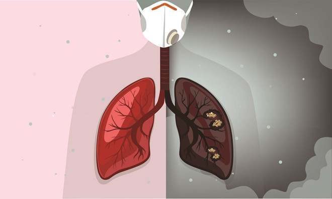 Bị u phổi ác tính sống được bao lâu và điều trị tích cực như thế nào?