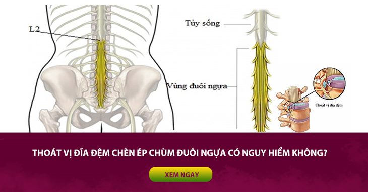 Thoát vị đĩa đệm chèn ép chùm đuôi ngựa có nguy hiểm không? 