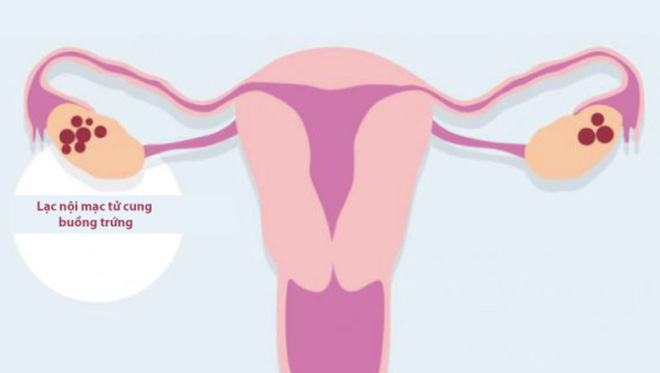 Phụ nữ bị lạc nội mạc tử cung buồng trứng cần lưu ý những vấn đề gì? Có thể điều trị bằng cách nào?