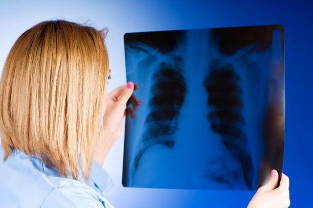 Cách phát hiện sớm và phòng ngừa ung thư phổi