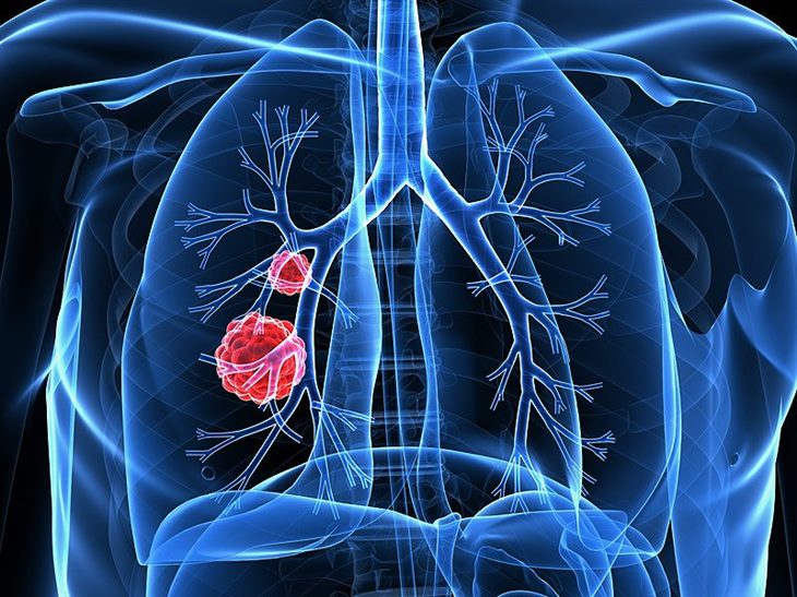 Chuyên gia Hồ Bá Do phân tích các phương pháp điều trị u phổi hiện nay