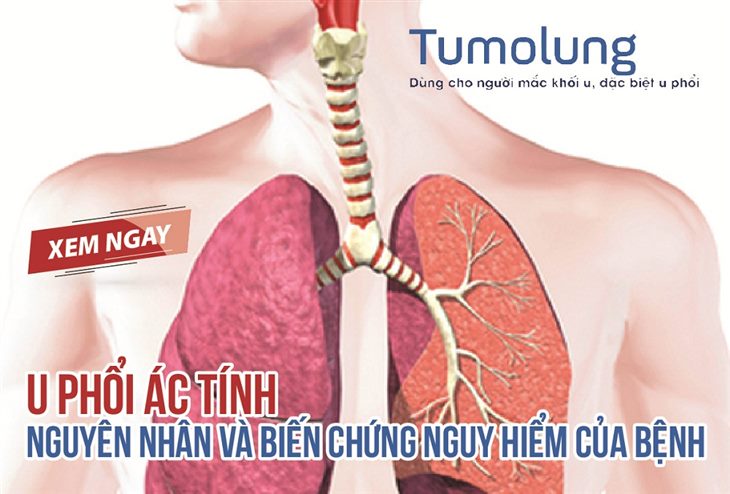 U phổi ác tính - Nguyên nhân và biến chứng nguy hiểm của bệnh. XEM NGAY!