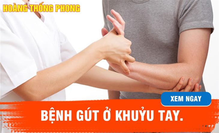 Bệnh gút ở khuỷu tay: Nguyên nhân, triệu chứng và cách cải thiện