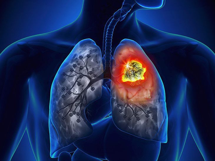 Người bị ung thư phổi giai đoạn cuối di căn sang tim điều trị như thế nào?
